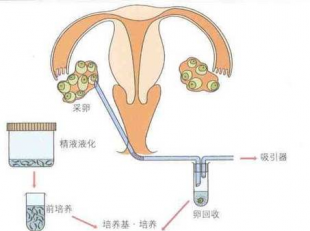 促排卵激素对正常女性的副作用